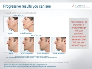 KyBella-Double-Chin-countouring-NKY-Cincinnati-Permanent-Fat-Removal-Nonsurgical