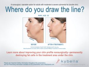 KyBella-NKY-Cincinnati-Permanent-Fat-Removal-Nonsurgical