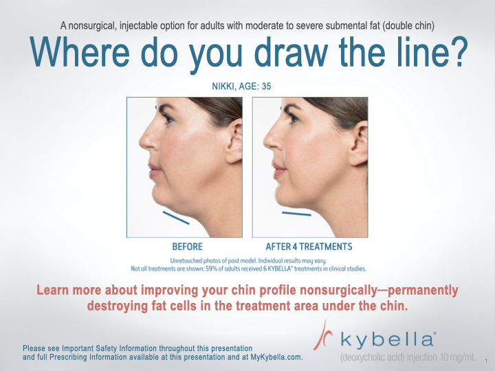 KyBella-NKY-Cincinnati-Permanent-Fat-Removal-Nonsurgical