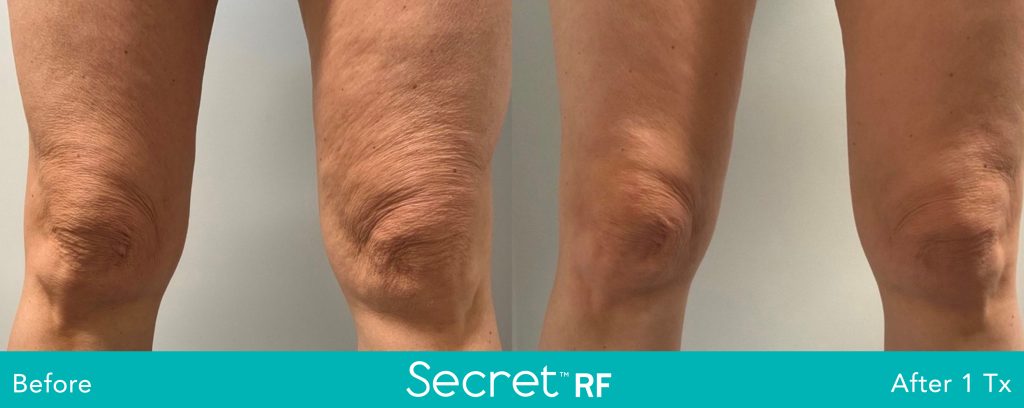 Secret RF-Skin Tightening-Knees-Loose Skin-Laser Treatments