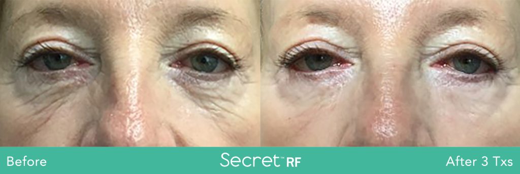 Secret RF-Skin Tightening Under Eyes-NKY