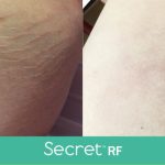 SecretRF-Stretch Marks-NKY-Cincinnati-Zoe Grace Salon & Med Spa