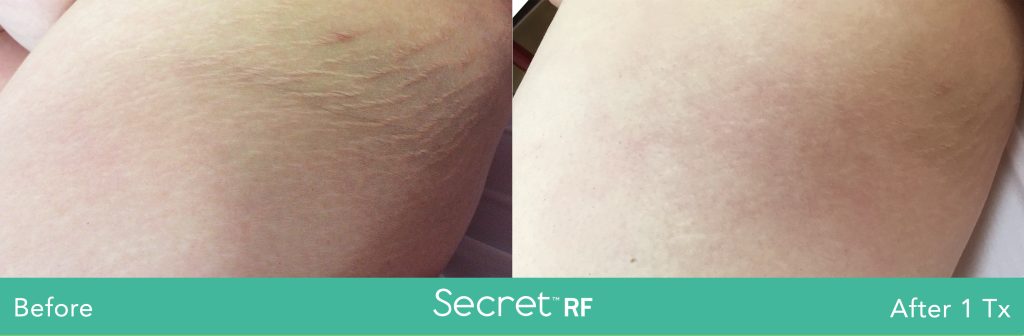 SecretRF-Stretch Marks-NKY-Cincinnati-Zoe Grace Salon & Med Spa