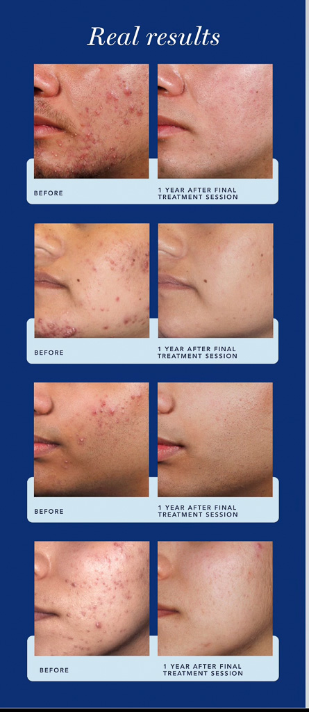 AviClear-Real-Results-Photo-1-Year-After-Treatment-Sessions