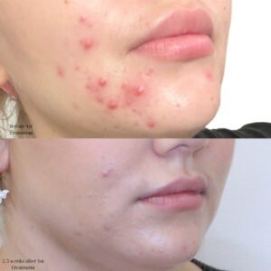 Aviclear before and after results -2