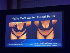 Side-by-side photos of a woman’s torso labeled "before" and "after" showing physical changes following 4 weeks of body contouring treatments.