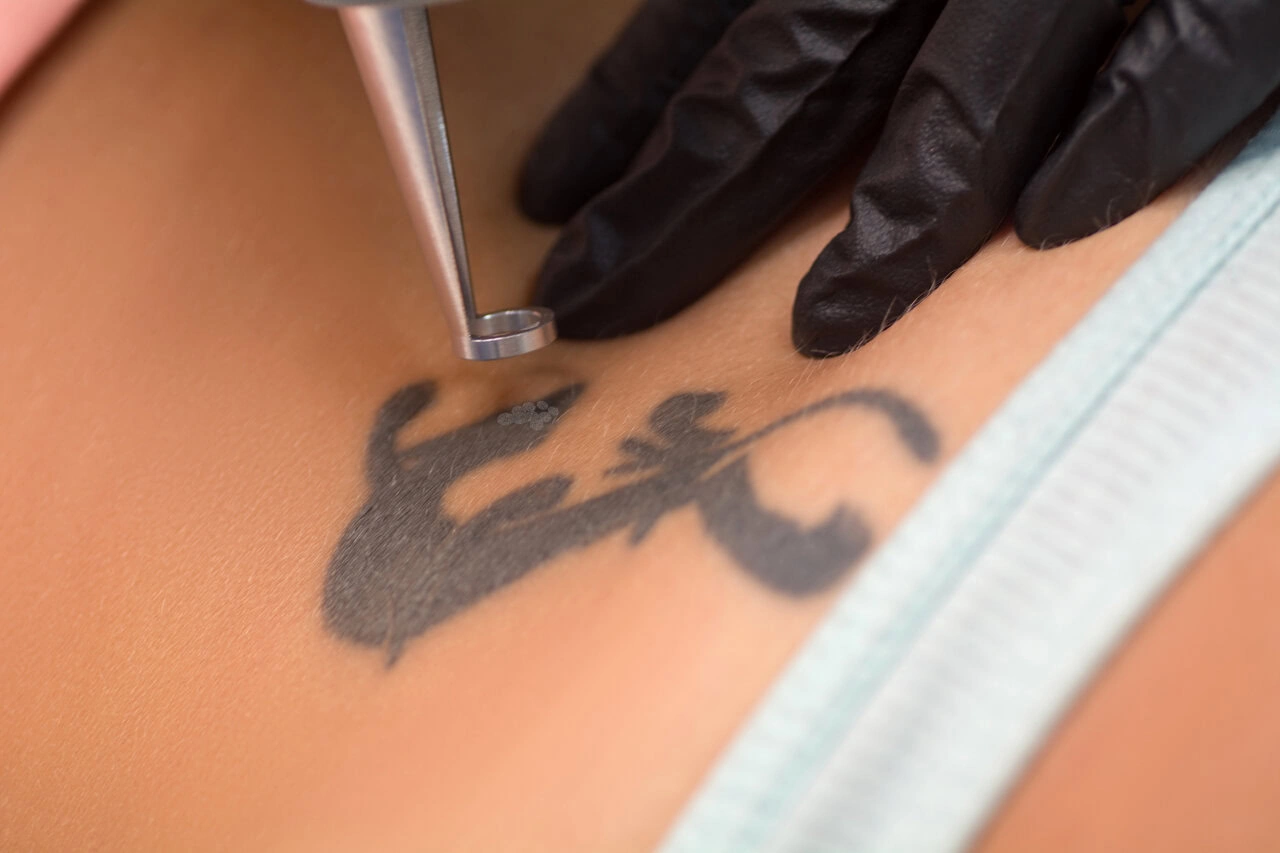 Close-up of a gloved hand using a laser device to remove a black tattoo from a person's skin near the shoulder.