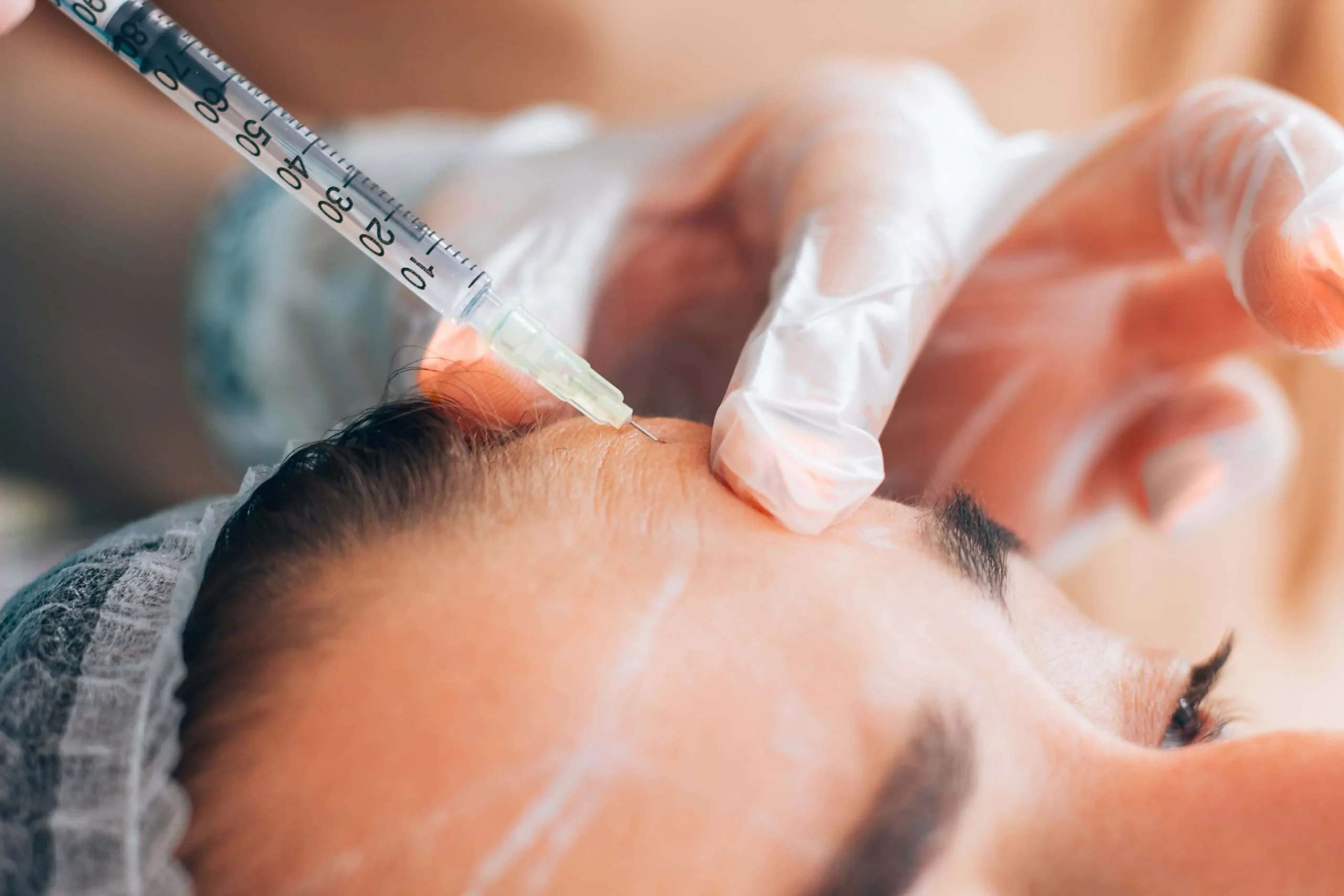 A gloved hand injects a syringe into a person's forehead, likely for a cosmetic procedure such as Botox, with white guideline marks visible on the skin.