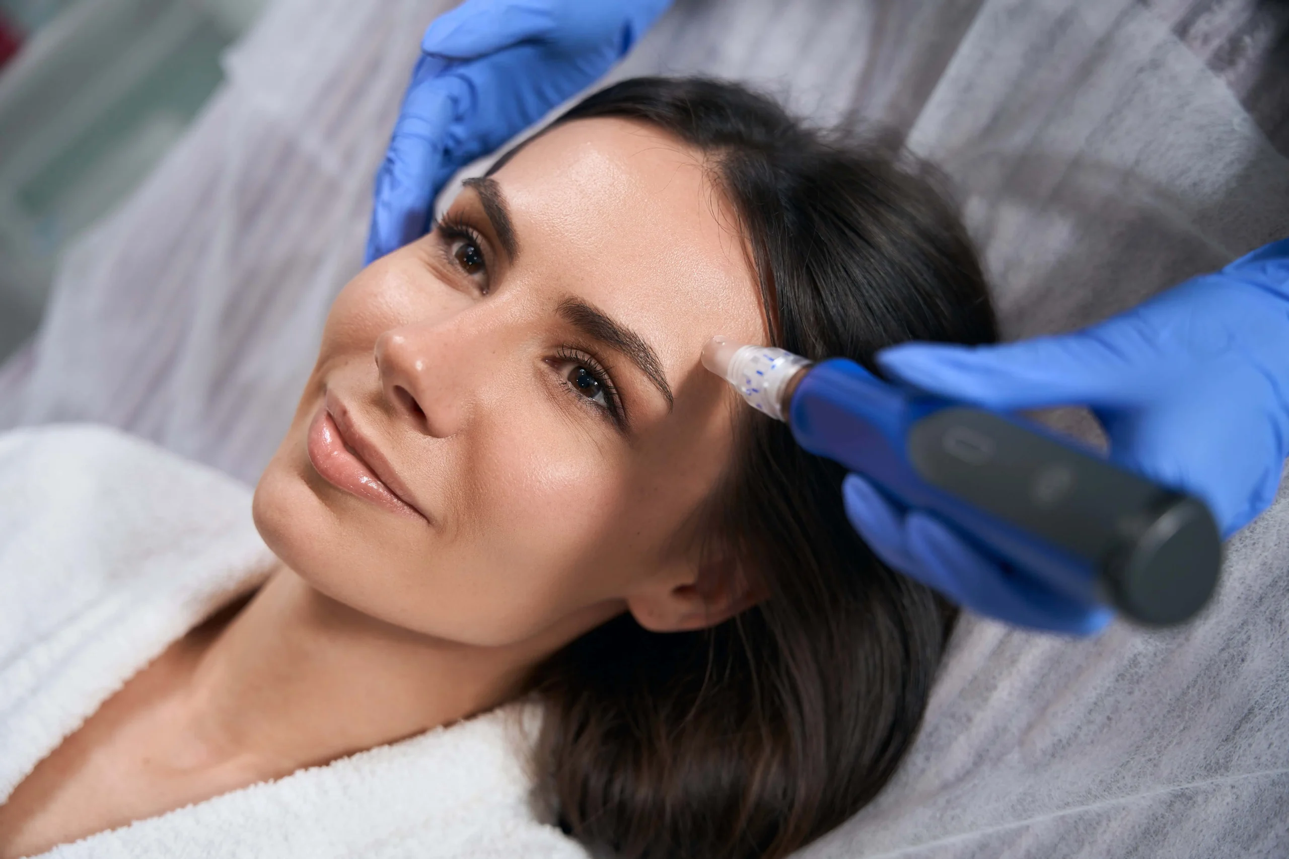 A woman lies on a treatment bed while a person wearing blue gloves performs a facial procedure with a microneedling device on her forehead.
