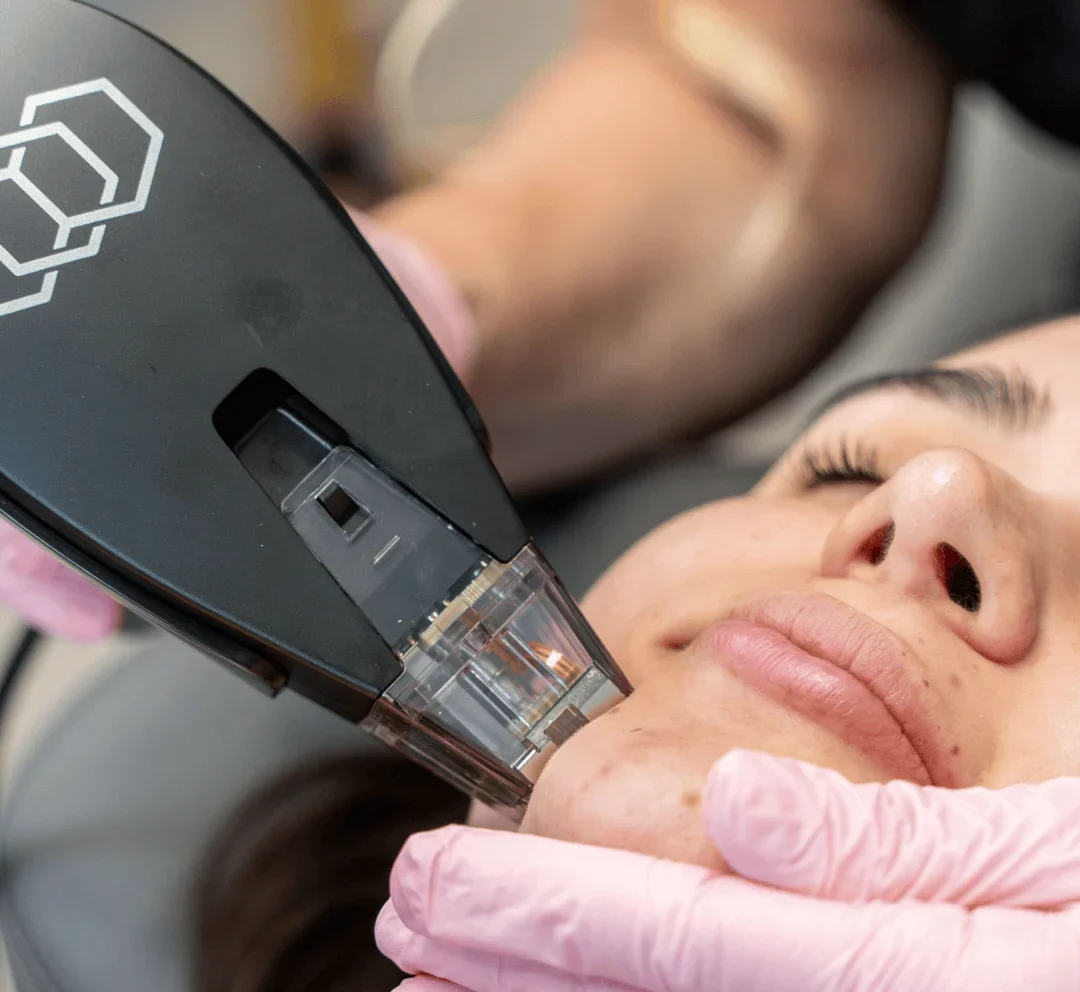 A person receives a laser treatment on their face, with a hand wearing pink gloves gently holding their chin during the procedure.
