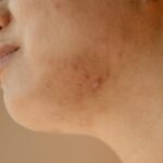 Acne Scars