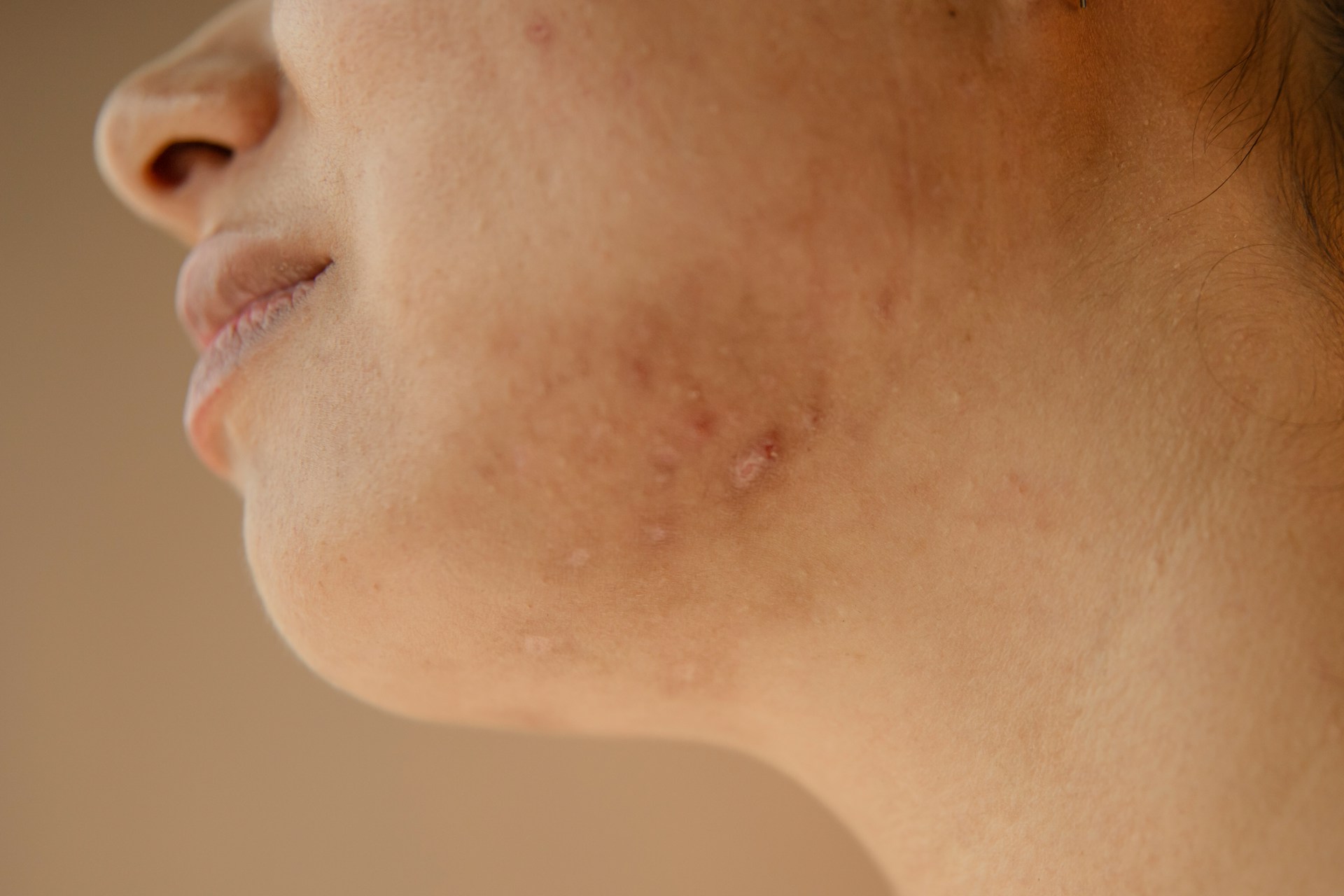 Acne Scars