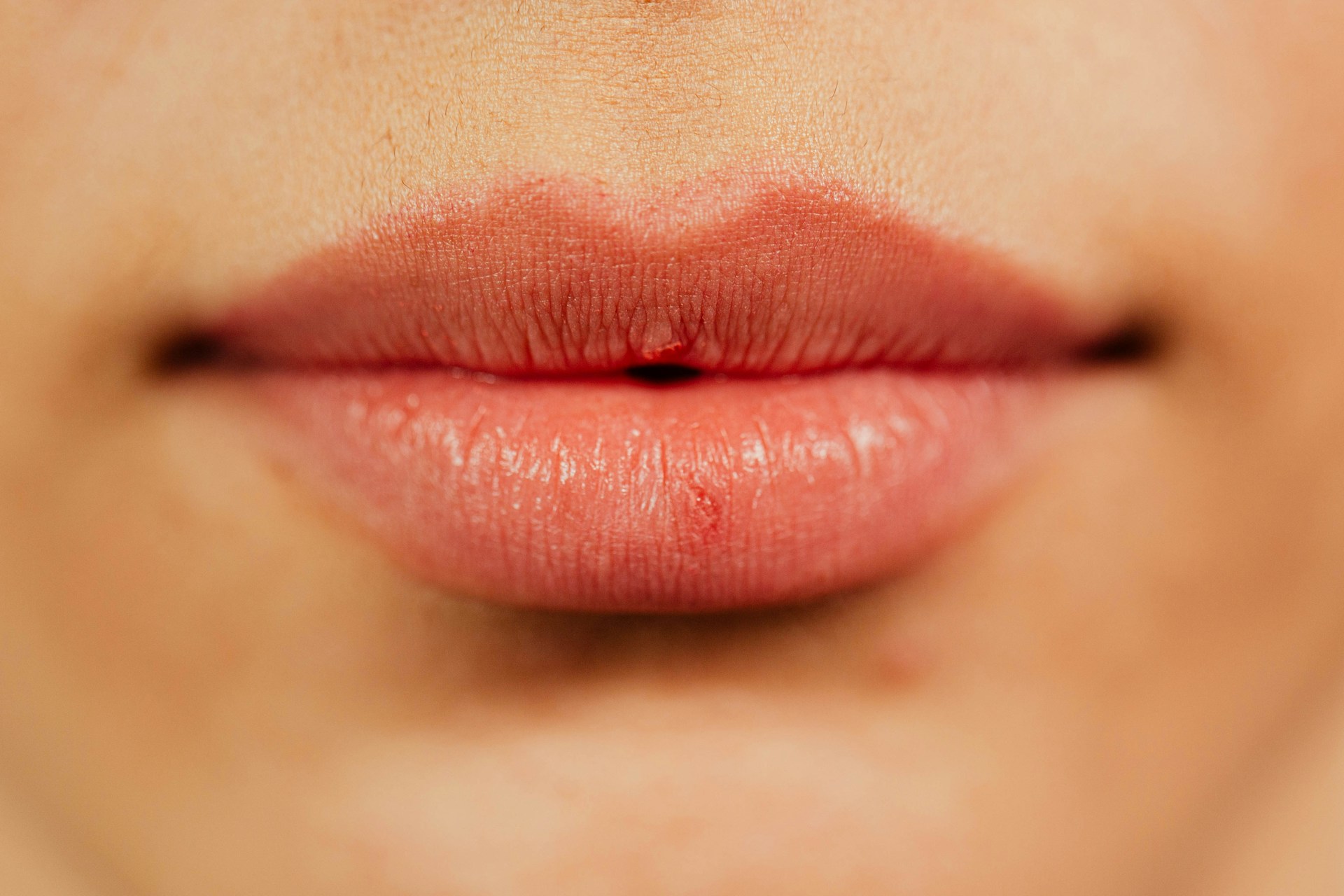 lip filler