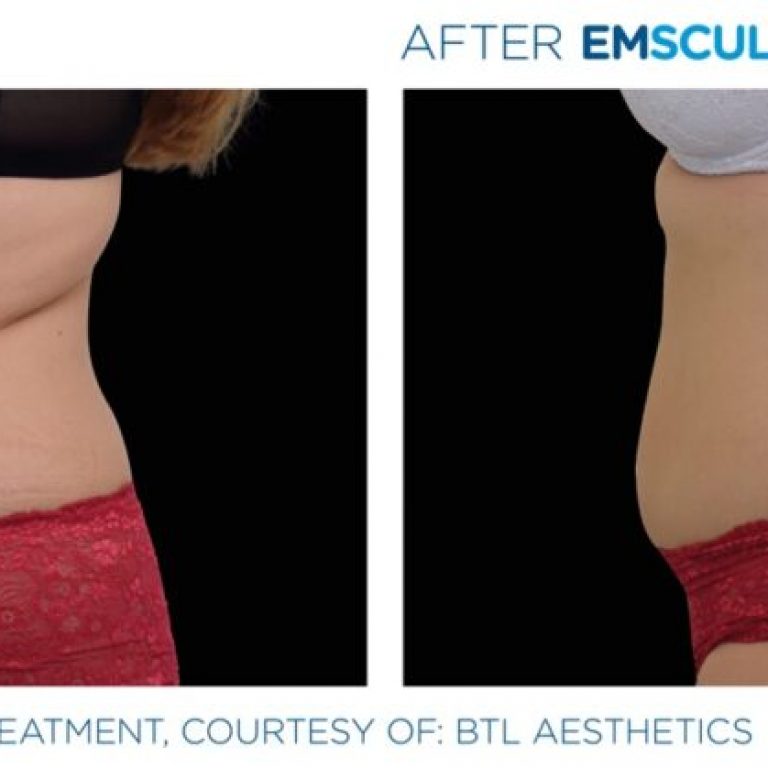 Flanks Non-Invasive Before and After Photo NKY