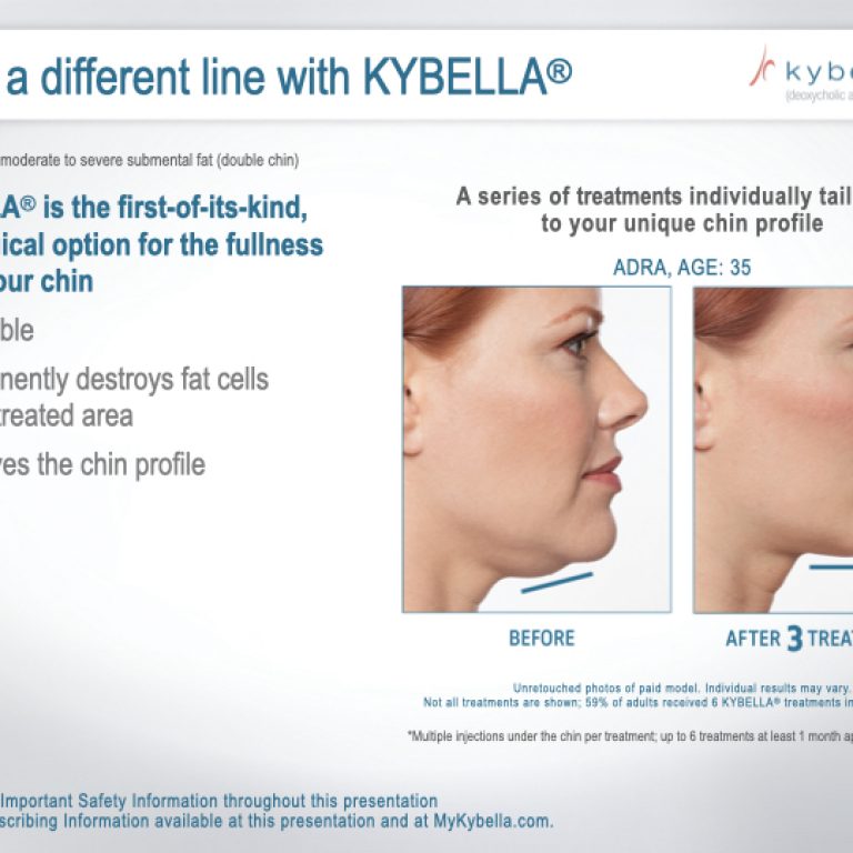 KyBella-Northern-KY-Cincinnati-Permanent-Submental-Fat-Removal-Nonsurgical