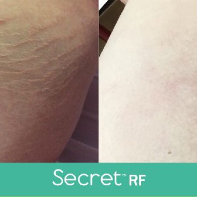 SecretRF-Stretch Marks-NKY-Cincinnati-Zoe Grace Salon & Med Spa
