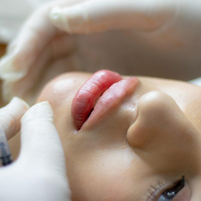 Lip Filler